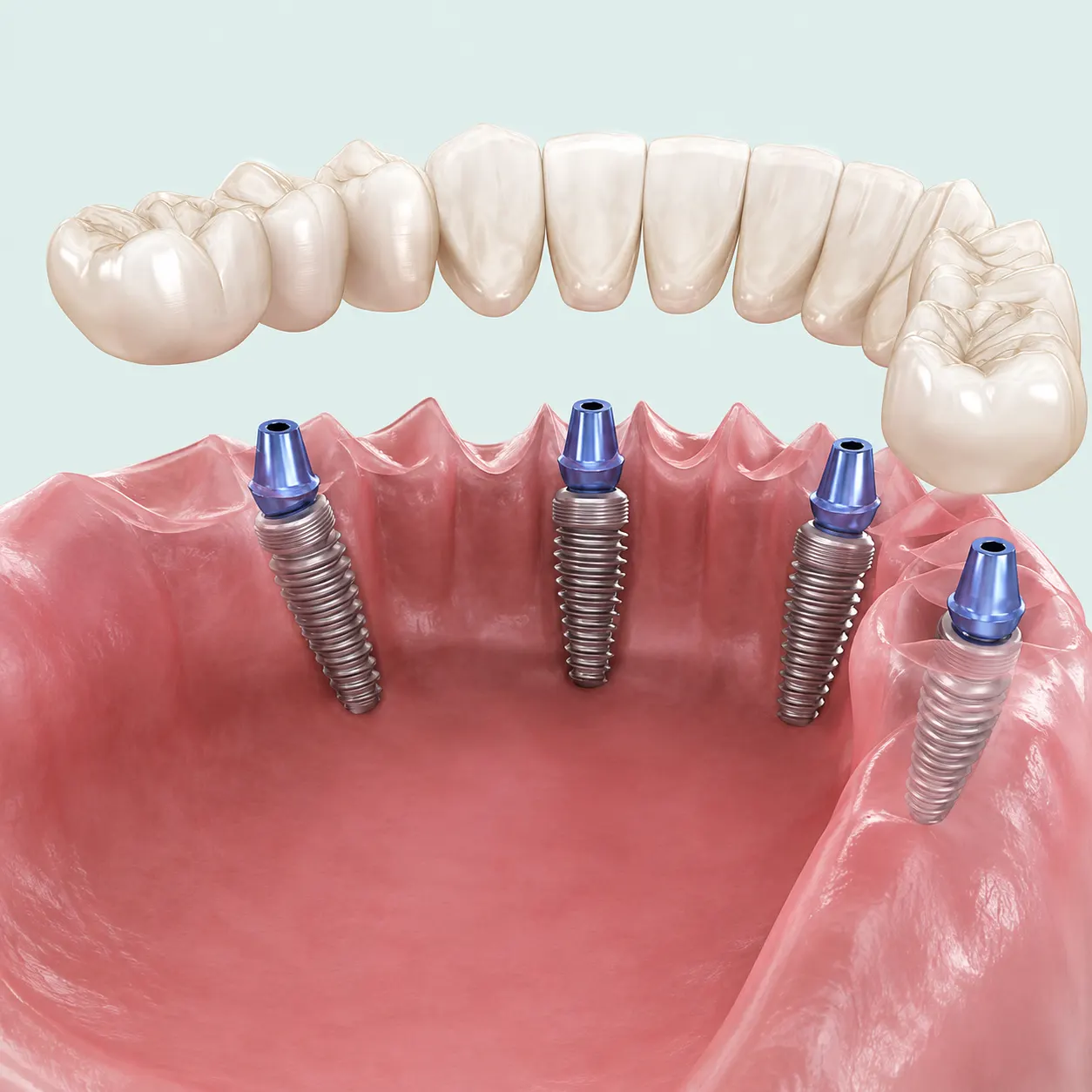 Arcade complète fixe sur implants : quatre implants dentaires portent une prothèse fixe pour toute la mâchoire du bas
