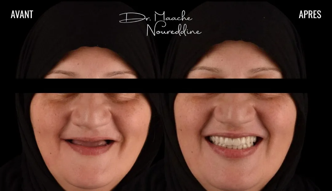 Avant et après : réhabilitation complète du sourire par implants dentaires, réalisée à la Zirconia Dental Clinic par le Dr. Maache Noureddine à Birkhadem, Alger