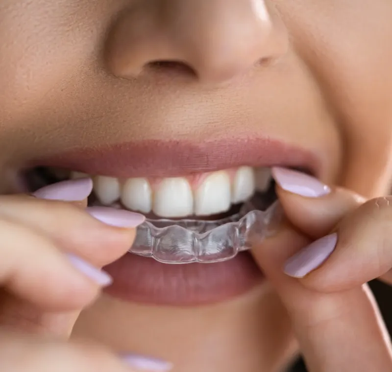 Pose d'une gouttière d'orthodontie transparente — traitement d'alignement dentaire à Birkhadem, Alger