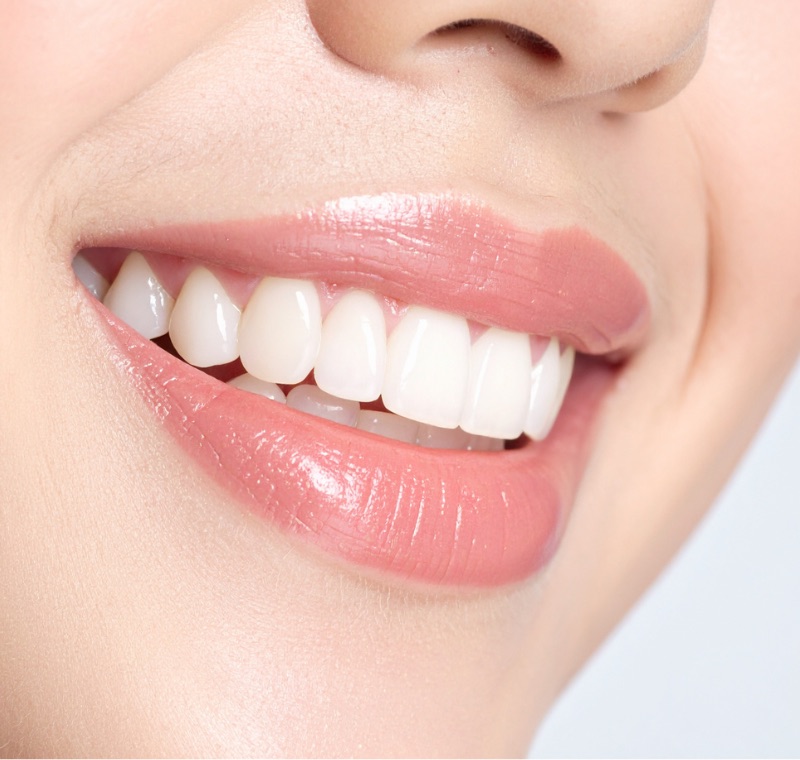 Sourire éclatant après un blanchiment dentaire à la Zirconia Dental Clinic, Birkhadem, Alger