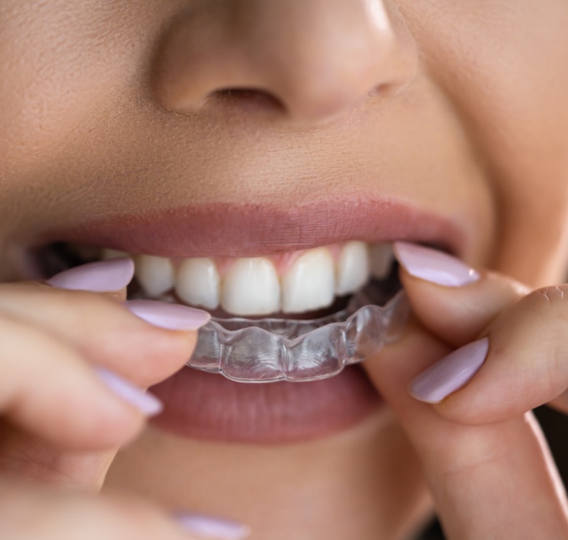 Pose d'une gouttière d'orthodontie transparente — traitement d'alignement dentaire à Birkhadem, Alger